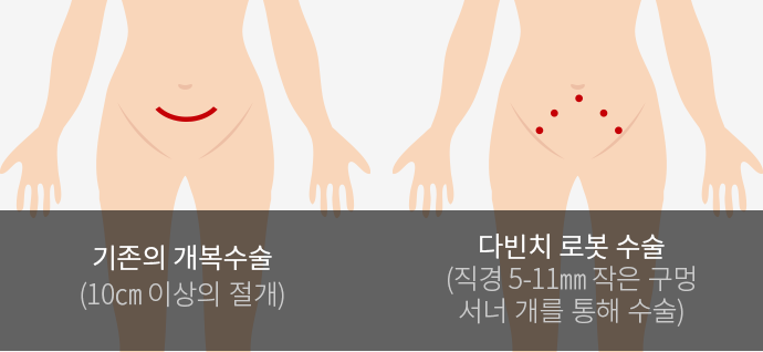 자궁경부암/자궁내막암/난소암