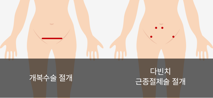 자궁근종