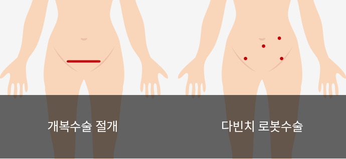 종격 종양