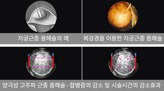 자궁근종 용해술
